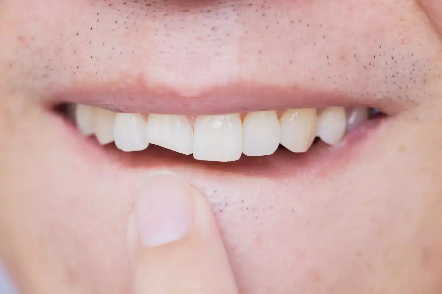 Les conséquences d’une dent cassée et comment les éviter