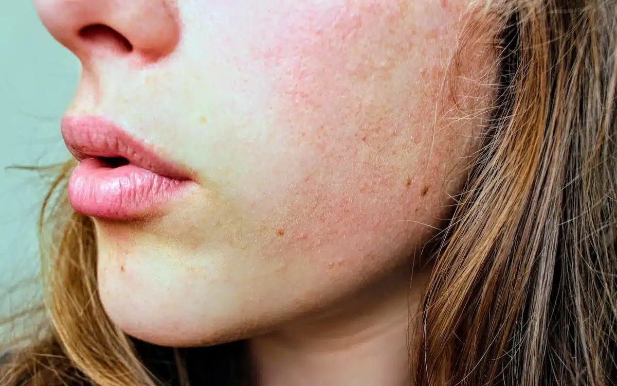 symptômes  diagnostic