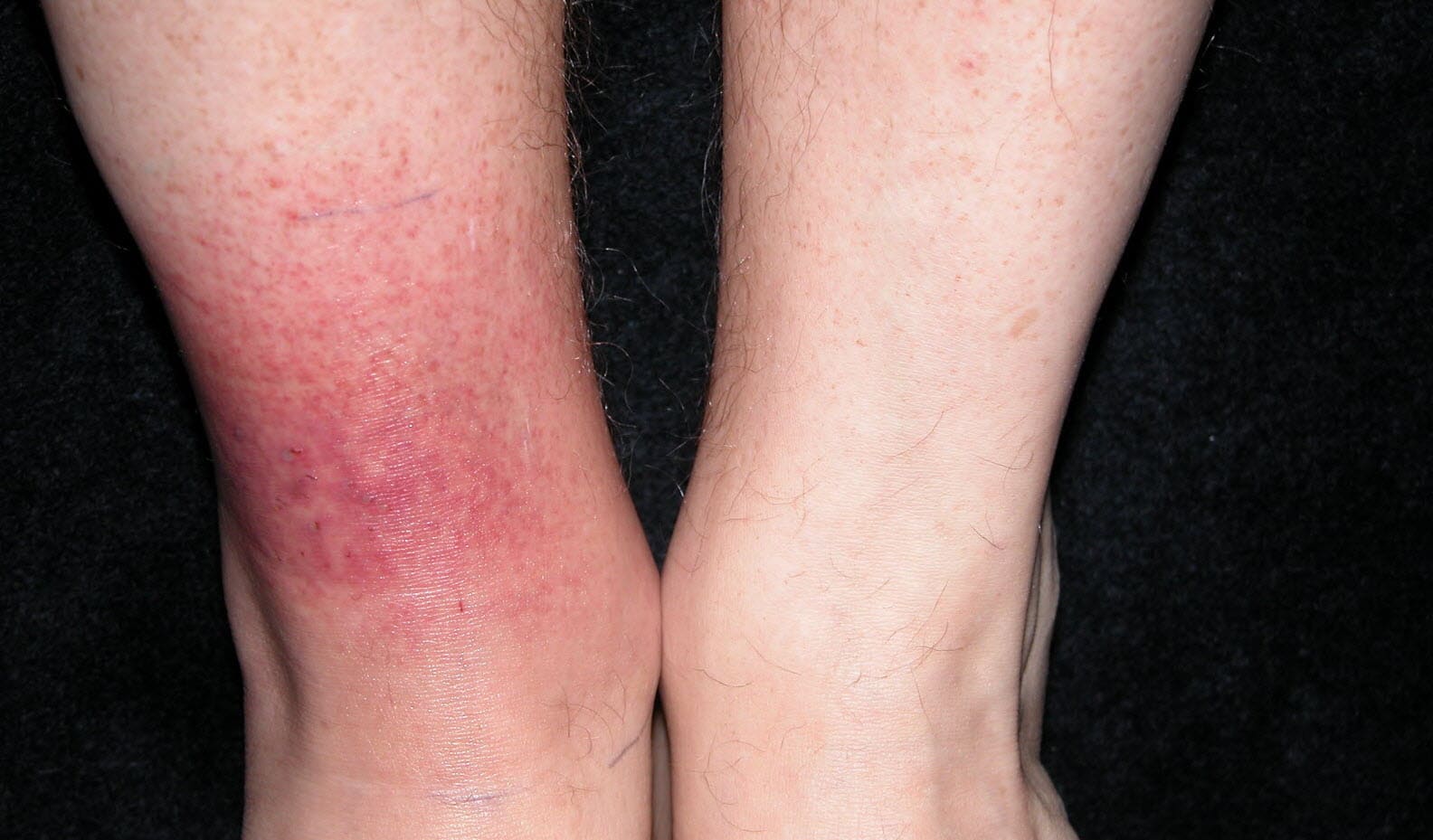 Quel symptôme pour la maladie de Lyme ?