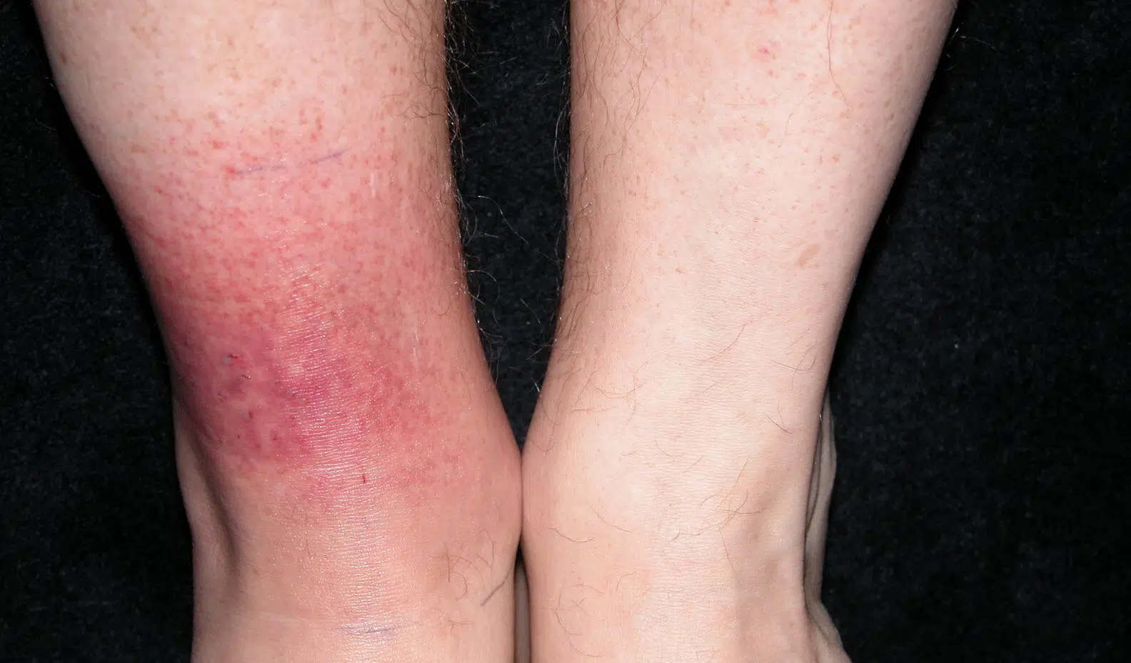 Quel symptôme pour la maladie de Lyme ?