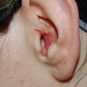 Eczéma dans l’oreille : comment le soigner ?