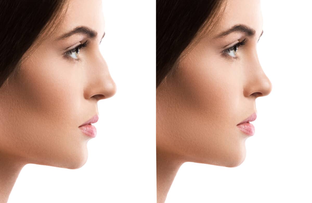 Comprendre le principe de la rhinoplastie ultrasonique